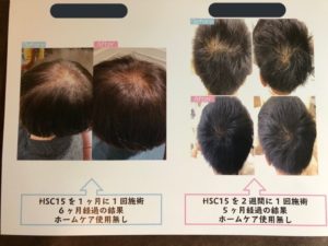 AGA鍼治療+ヒト幹細胞培養液の掲載写真 2