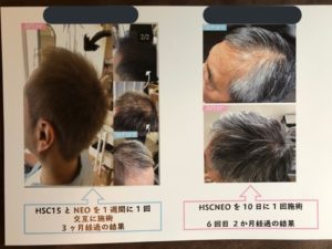 AGA鍼治療+ヒト幹細胞培養液の掲載写真 3