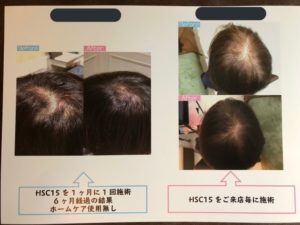 AGA鍼治療+ヒト幹細胞培養液の掲載写真 4